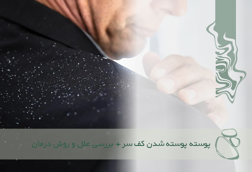 درمان پوسته پوسته شدن پوست سر + بررسی علت پوست انداختن کف سر